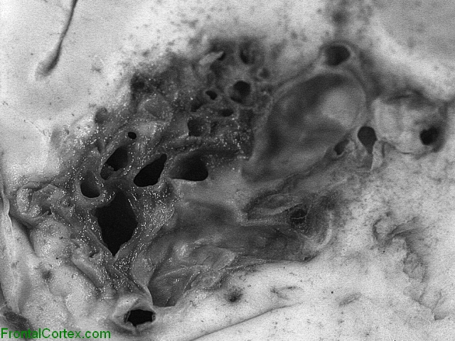 Arteriovenous malformation, coronal section, close-up